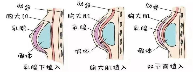 合肥隆胸专家排名公布，钟茜、臧曙光医生都可信赖