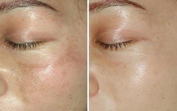 武汉激光祛斑医院排名，韩辰、美基元、长江航运总医院等上榜