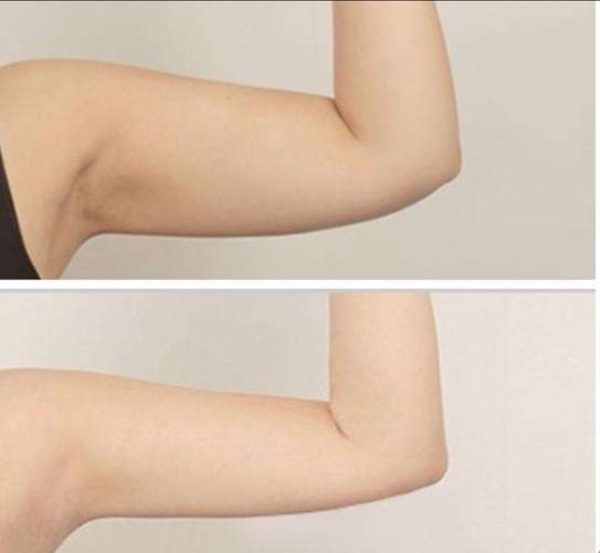 阜阳吸脂手术医院哪家好？佳美、壹加壹、第五人民医院等权威对比！